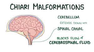 Glioma Surgery